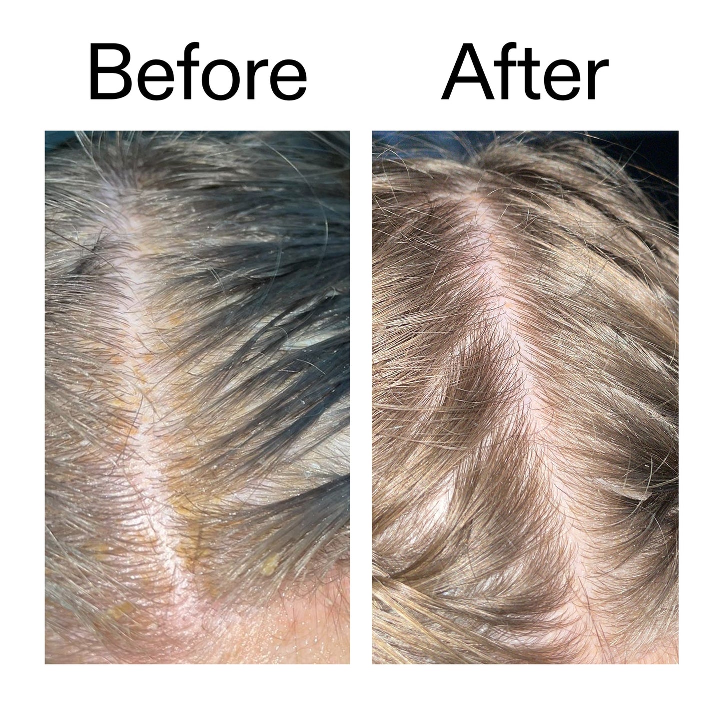 salicylic-acid-exfoliating-scalp-treatment-n5 Salicylic_Acid_Exfoliating_Scalp_Treatment_Before_After_2000x2000_e572a30f-057c-4a48-823b-1c09dc97f8d0.jpg