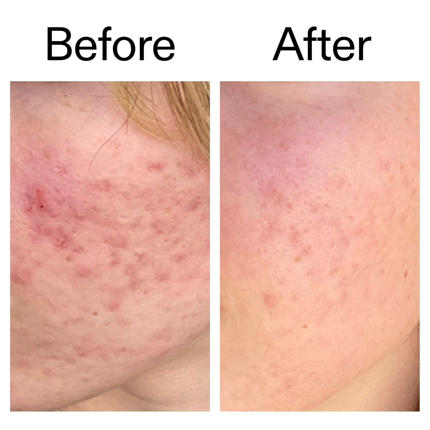 10-azelaic-acid-serum-for-redness-relief-a5 Azealic_Acid_Serum_B_A_Ppage_2000_x_2000.jpg