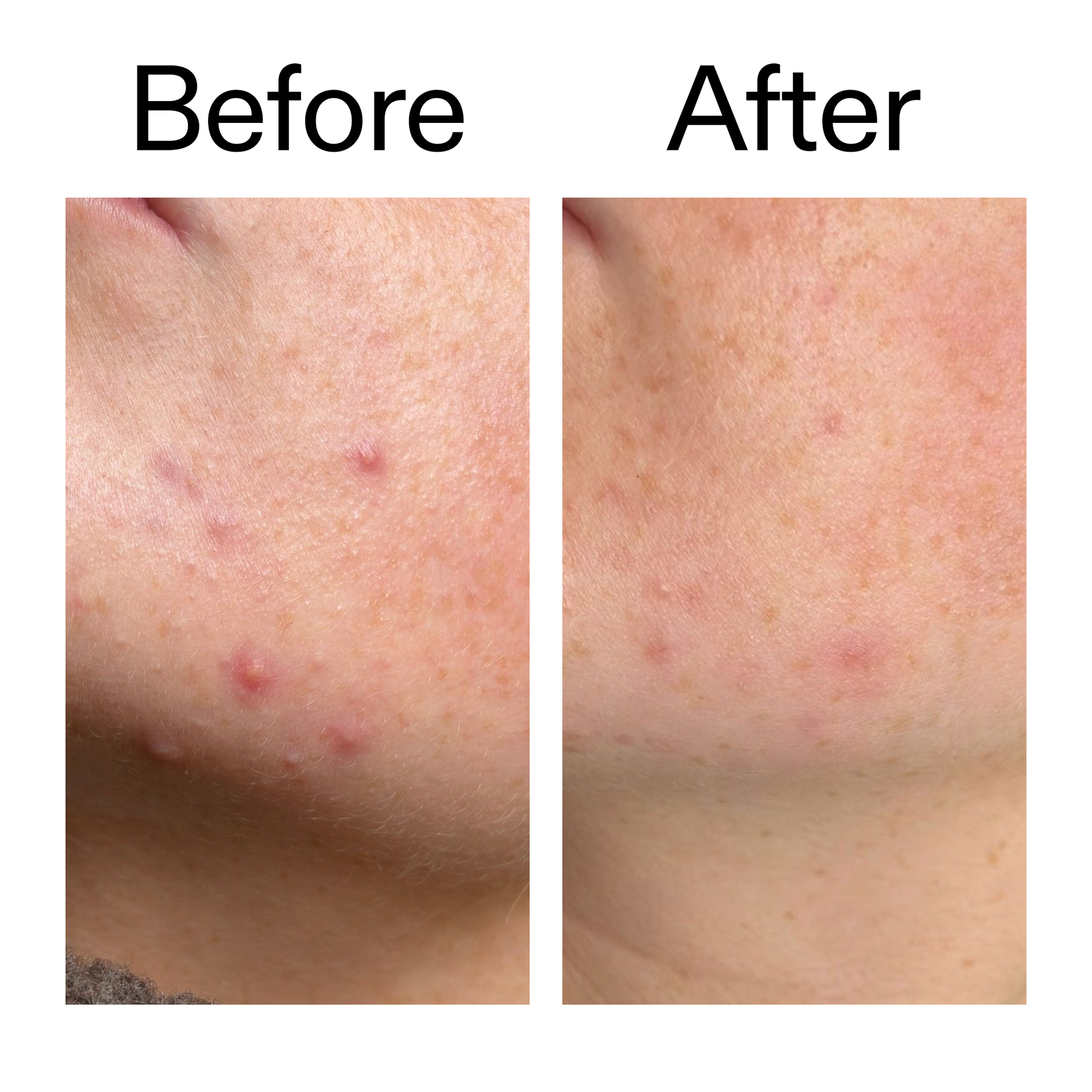 10-azelaic-acid-serum-for-redness-relief-a5 B_A_1_PPAGE.png