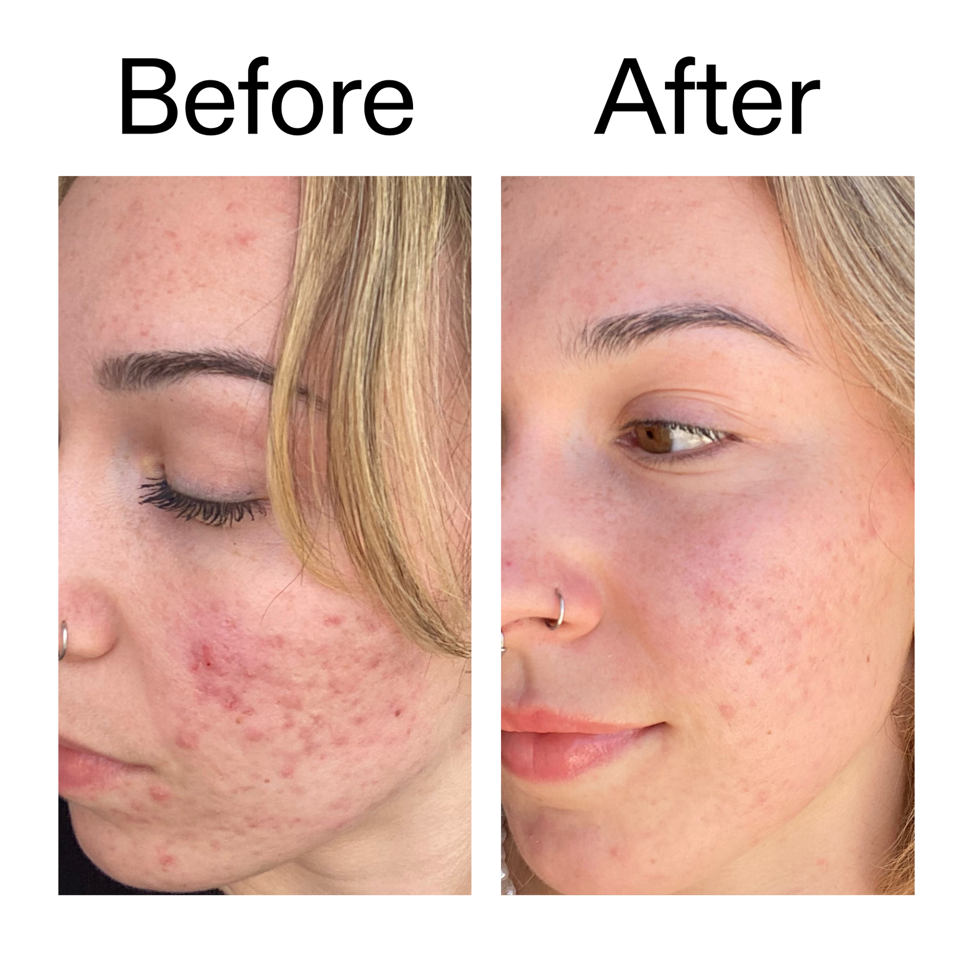 10-azelaic-acid-serum-for-redness-relief-a5 B_A_2_PPAGE.png