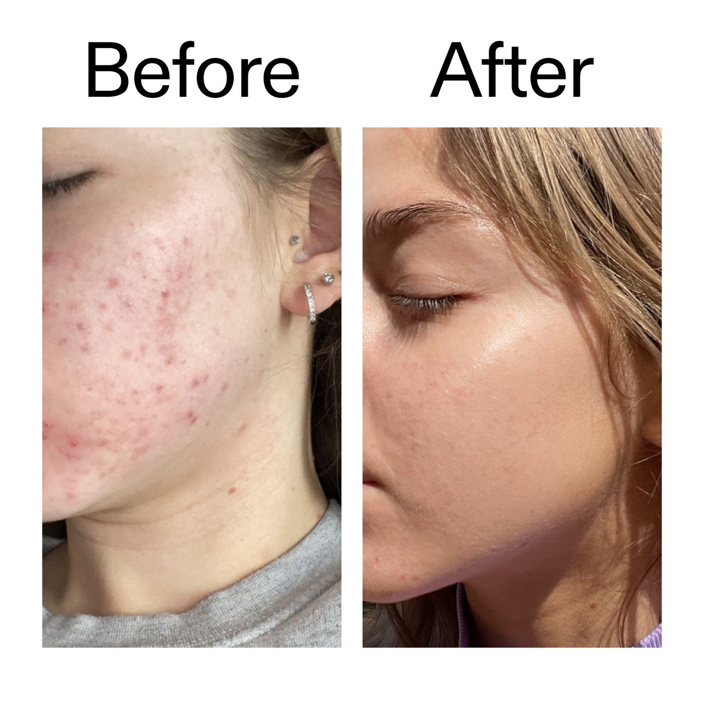 beta-hydroxy-acid-bha-serum-v0 Beta_Hydroxy_Acid_Serum_Before_After_2000x2000_96fda3e5-938d-49ef-bcf2-a0fa6ece4e2c.jpg