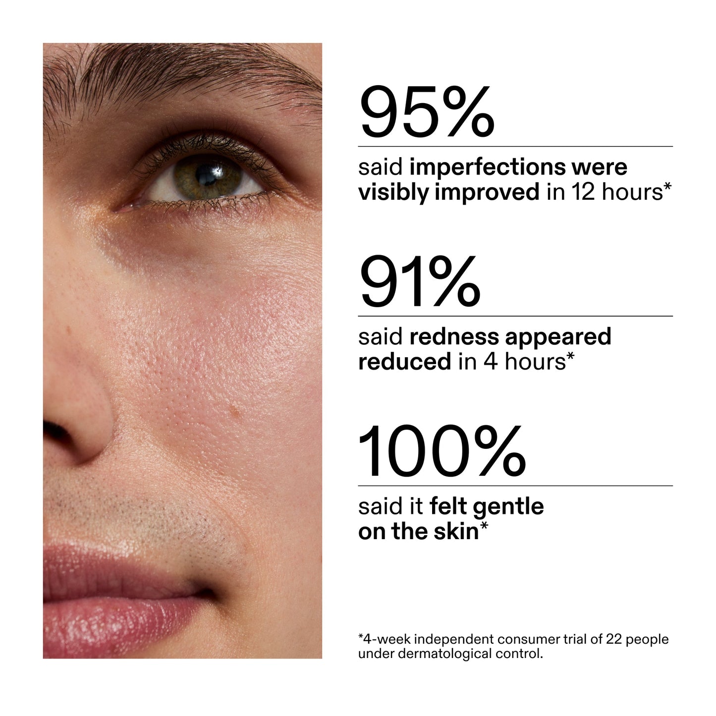 succinic-acid-acne-treatment-a4 CA_Succinic_Acid_Treatment_key_Claims_2000x2000_db91b0f1-7f29-4bfe-bb16-63a47f500960.jpg