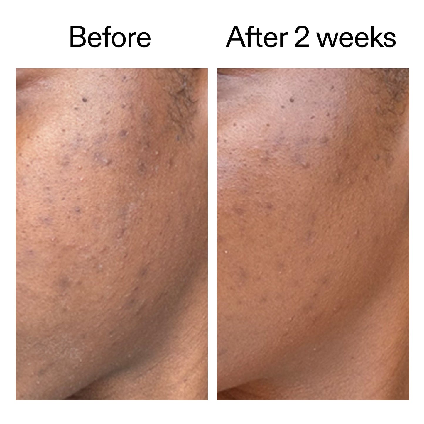 360-acne-clearing-serum-k9 DIOICB_A2000x2000.jpg