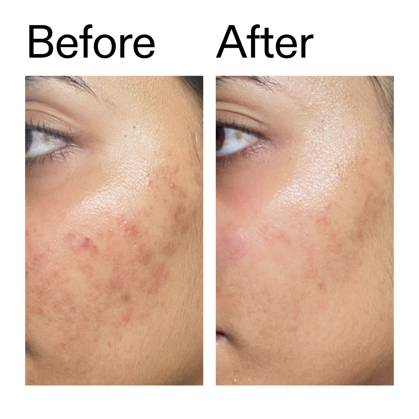 ectoin-hydro-barrier-serum-duo-z5 Ectoin_Hydro-barrier_Serum__Before_After_2000x2000_34261920-d004-48d0-9c7b-8e1c15971bfd.jpg