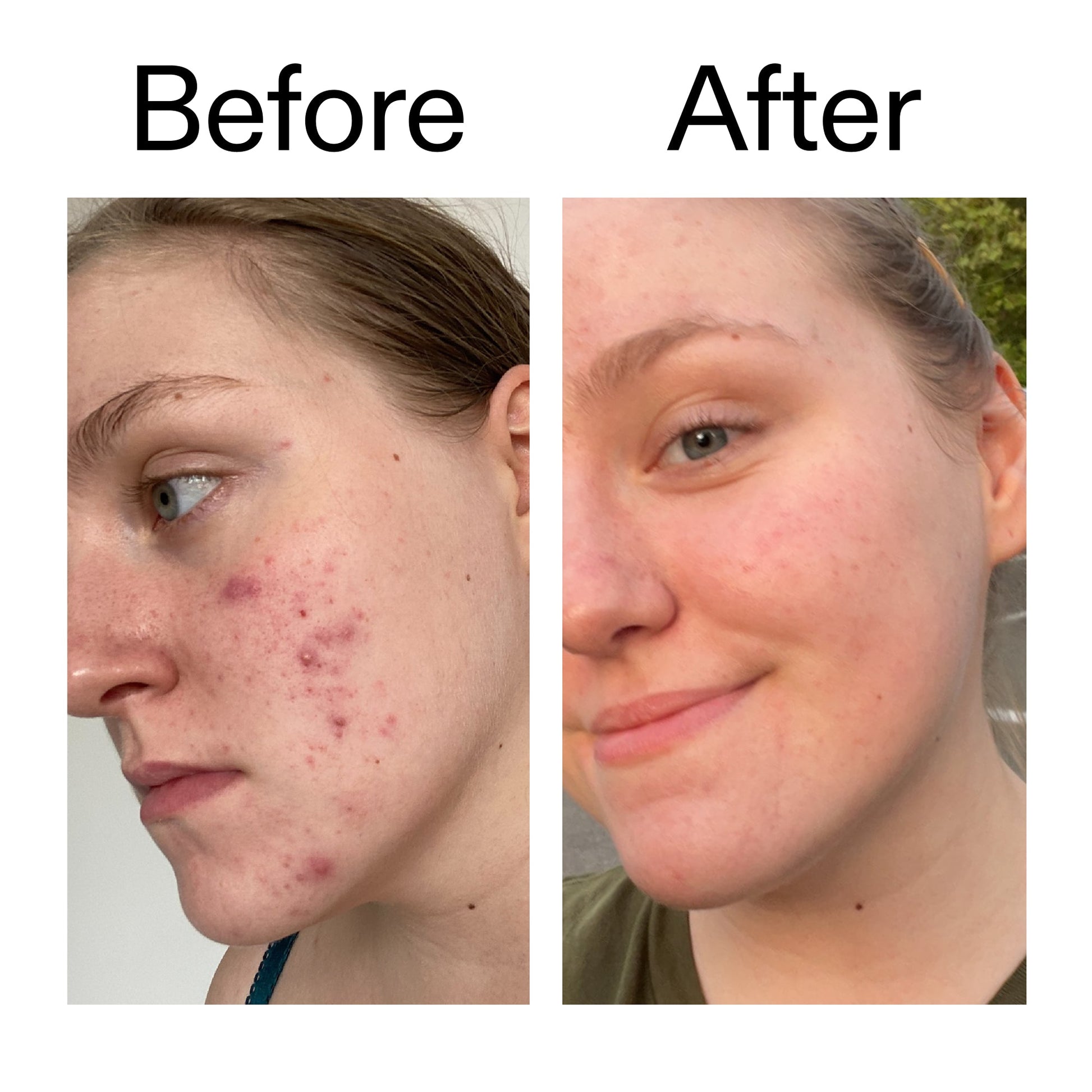 glycolic-acid-toner-d5 Glycolic_Acid_Toner_Before_After_2000x2000_49f0b9f7-e71b-4b2e-a8f8-2ea4b73247bb.jpg