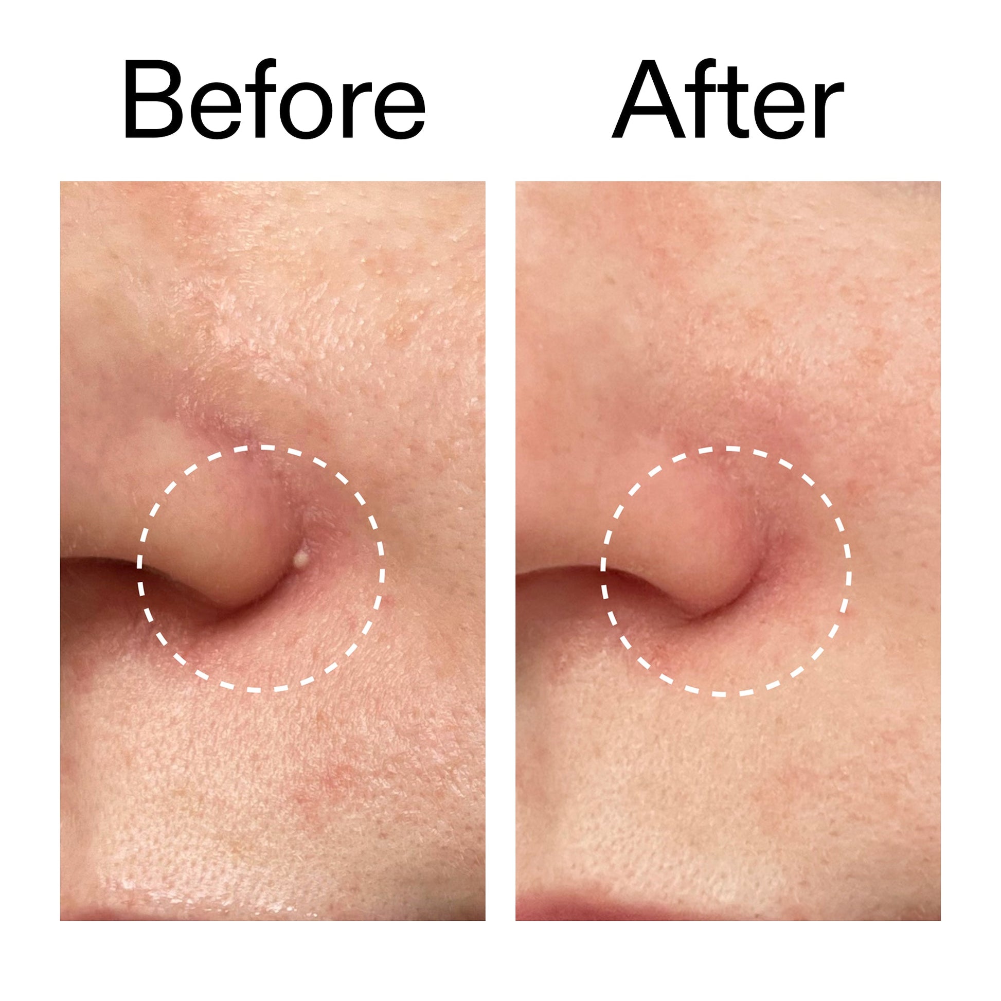 hydrocolloid-invisible-pimple-patches-pack-of-22-l4 Hydrocolloid_Invisible_Pimple_Patches_Before_After_2000x2000_b02aa37b-c78a-4682-91de-9135af5bb7df.jpg