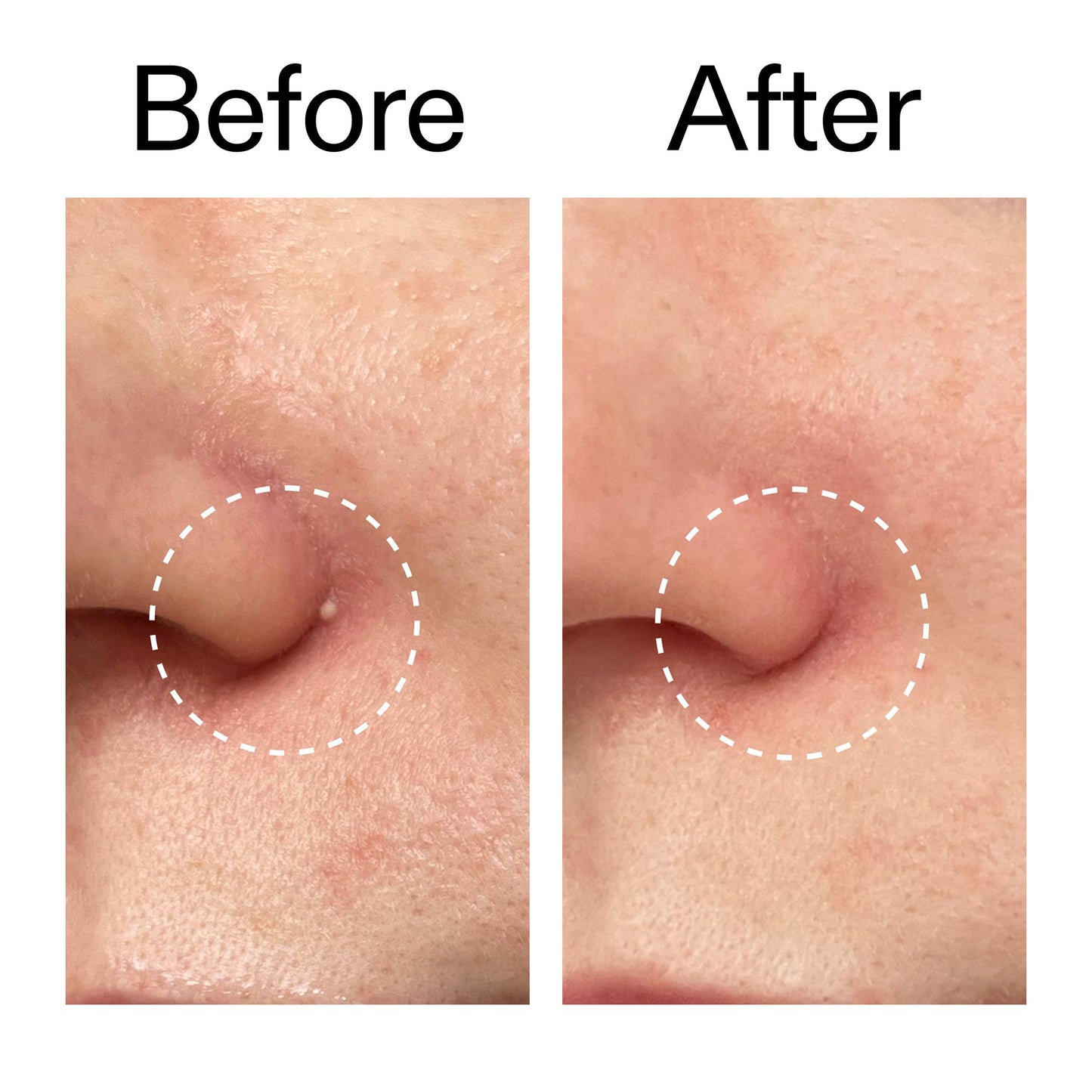 hydrocolloid-invisible-pimple-patches-pack-of-44-z6 Hydrocolloid_Invisible_Pimple_Patches_Before_After_2000x2000_b02aa37b-c78a-4682-91de-9135af5bb7df.jpg
