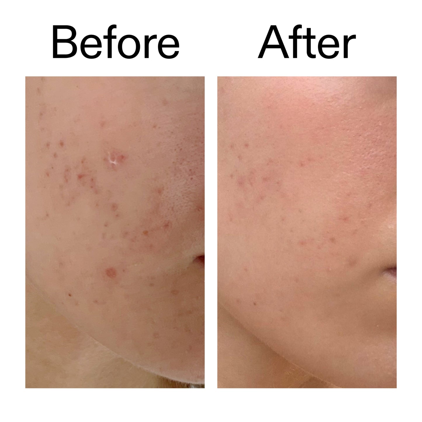 mandelic-acid-treatment-p9 Mandelic_Acid_Treatment_Before_After_2000x2000_4885ac6e-c5d7-4279-a72a-1417af7dce35.jpg