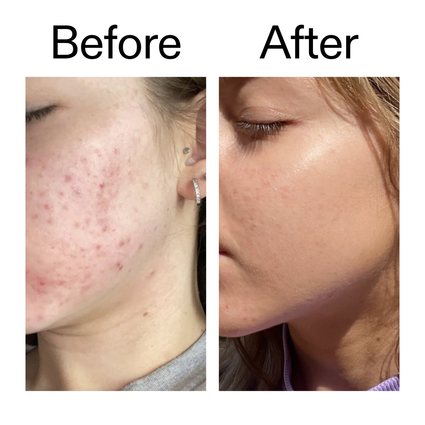10-niacinamide-serum-i1 Niacinamide_Serum_Before_After_2000x2000_bde32455-9e7d-448e-b053-bef41504f0a9.jpg