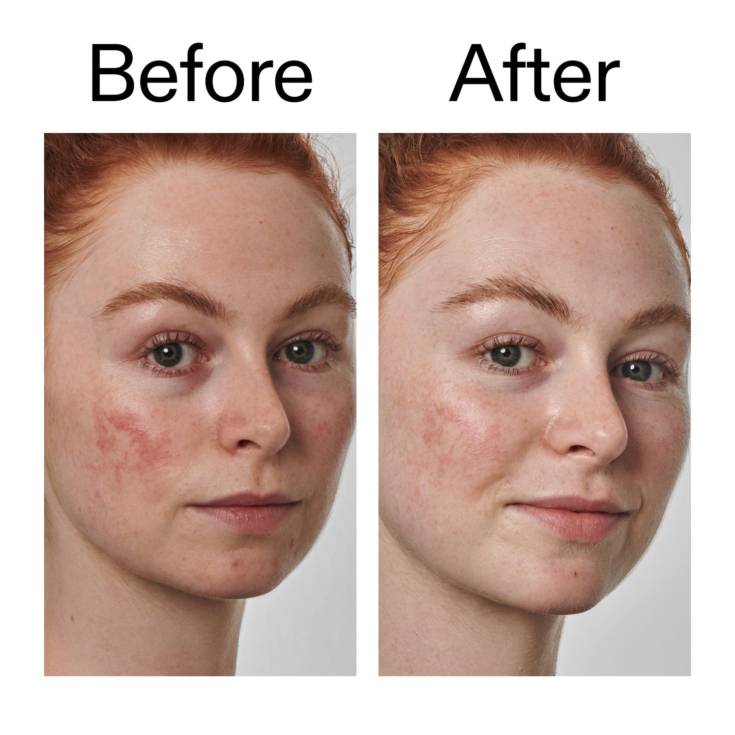 10-azelaic-acid-serum-for-redness-relief-a5 Redness_Relief_Serum_Before_After_2000x2000_3334dc9a-cce9-4e00-8aec-7ad89ca051f2.jpg
