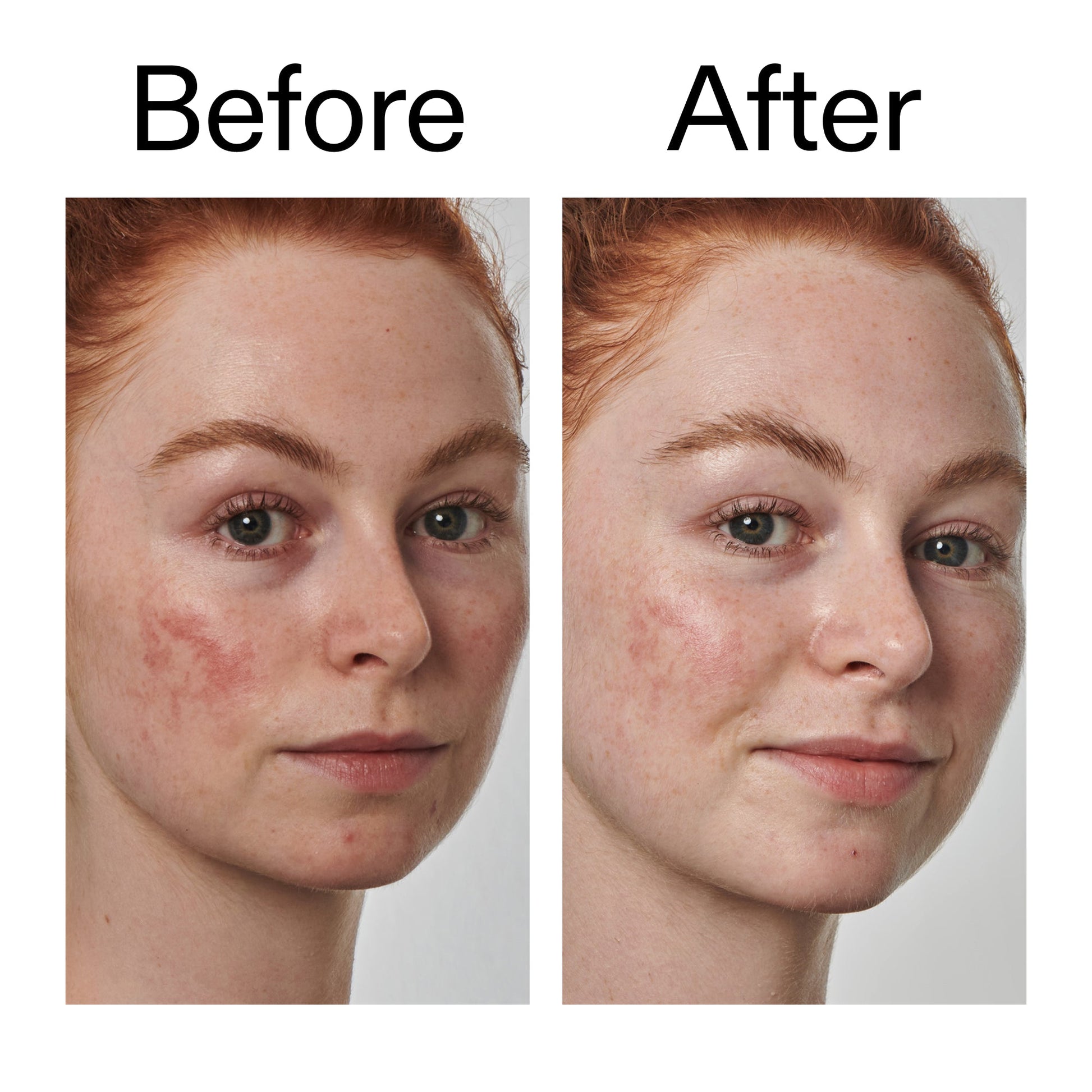 10-azelaic-acid-serum-for-redness-relief-a5 Redness_Relief_Serum_Before_After_2000x2000_3334dc9a-cce9-4e00-8aec-7ad89ca051f2.jpg