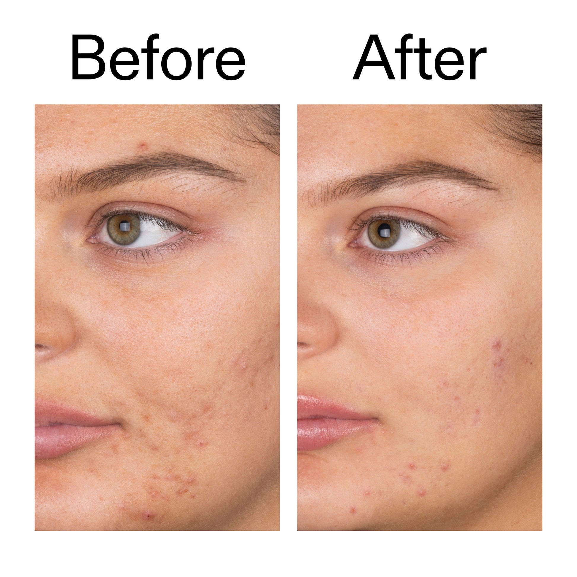 salicylic-acid-cleanser-150ml-c3 Salicylic_Acid_Cleanser_-_150ml_Before_After_2000x2000_e7230494-853f-4b07-82b1-27669104c995.jpg