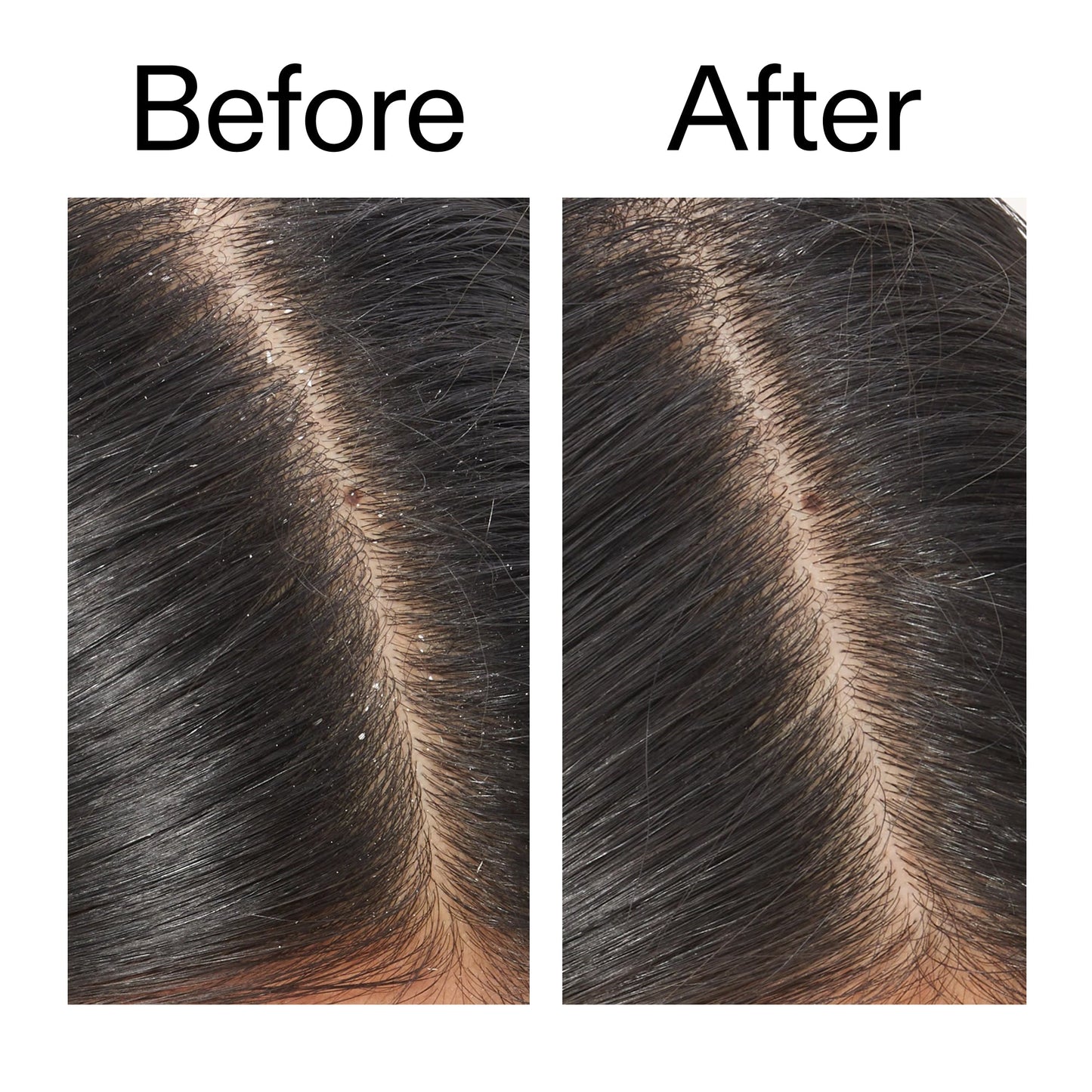 salicylic-acid-exfoliating-scalp-treatment-n5 Salicylic_Acid_Exfoliating_Scalp_Treatment_Before_After_V2_2000x2000_02bd61ad-42bf-490b-b3e3-7e04b2e8a673.jpg