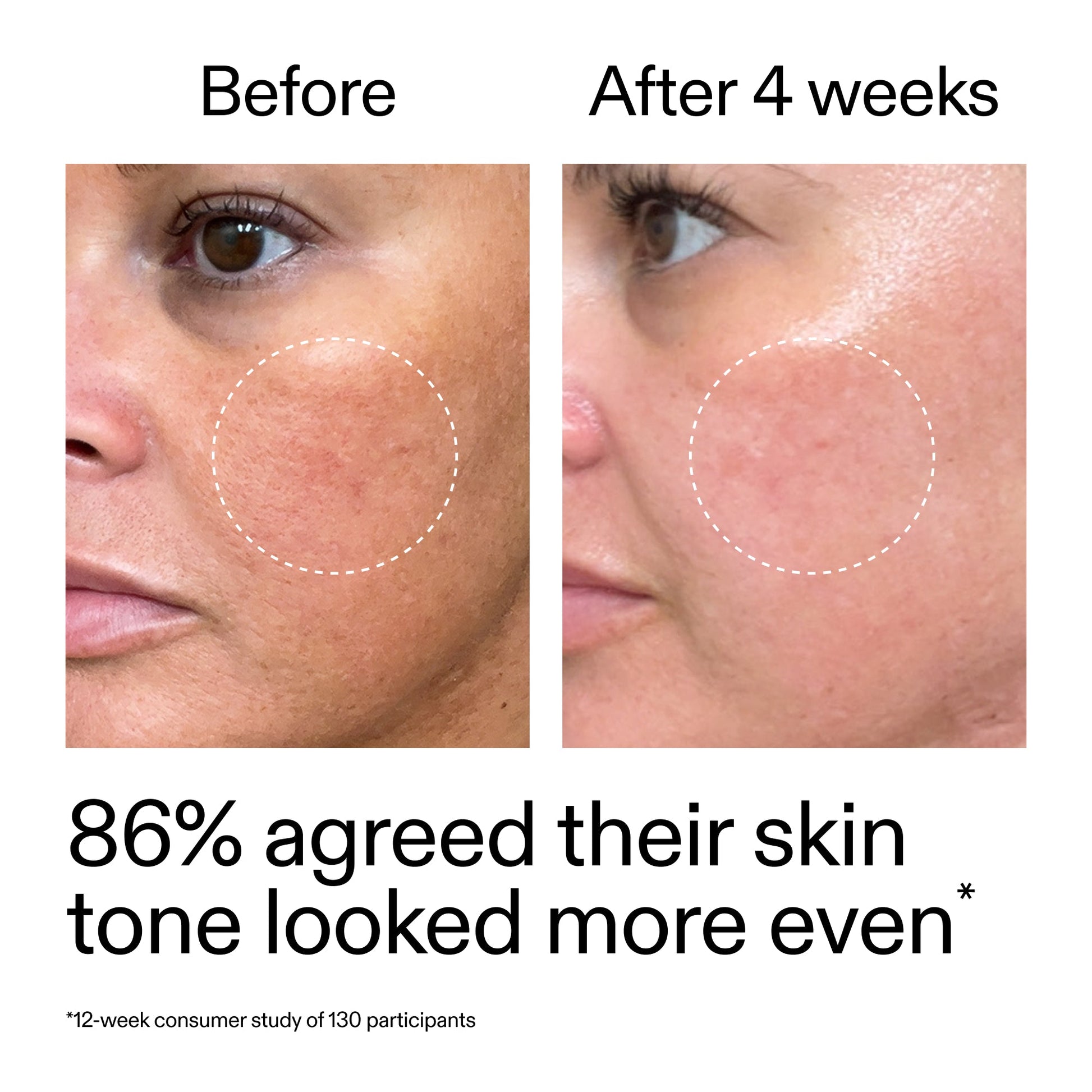 starter-retinol-serum-q5 StarterRetinol_BeforeAfter_Claim2_2000x2000_f5c9ecc0-8d76-429d-bef5-c3a61bcf5c09.jpg