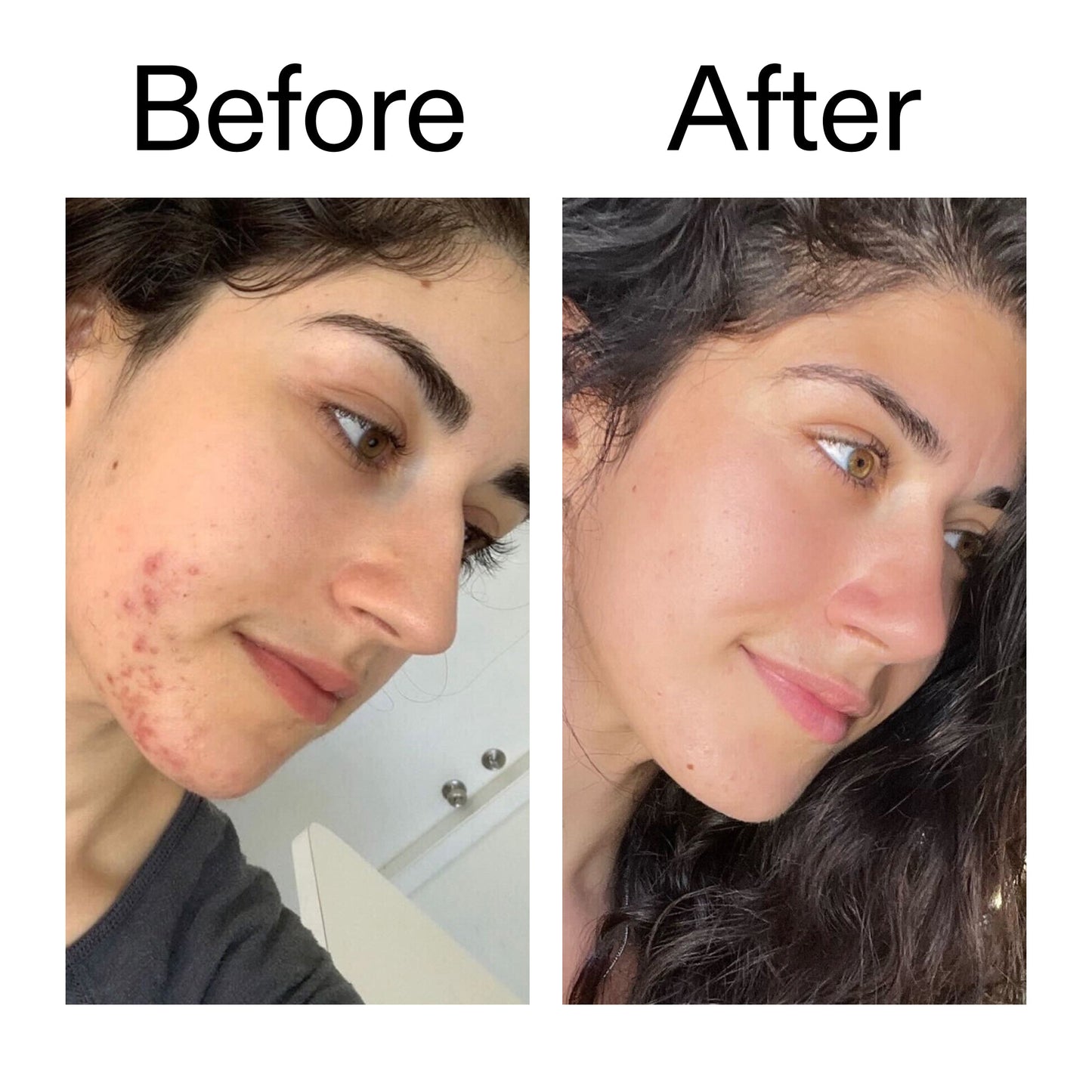 succinic-acid-acne-treatment-a4 Succinic_Acid_Treatment_Before_After_2000x2000_6a5f0054-2f58-4433-9314-0dc72c9bdd3b.jpg