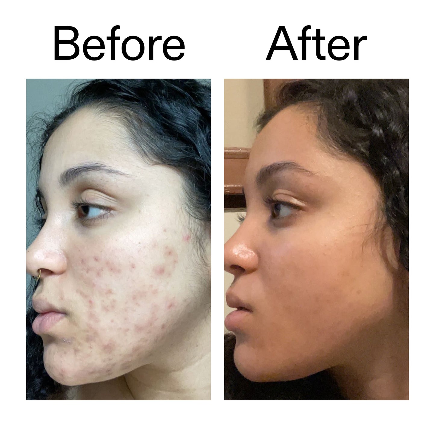tranexamic-acid-serum-n4 Tranexamic_Acid_Serum_Before_After_2000x2000_98ebc8be-77b0-4843-8a22-90790ebe918b.jpg