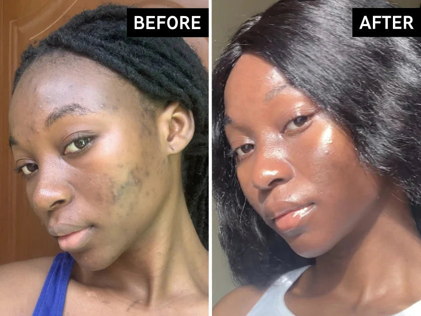 Before and after skin results